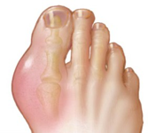 Gout typically affects the joints in the big toe.