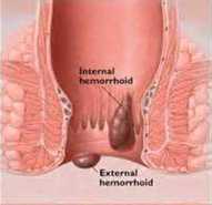 Internal hemorrhoids can manifest in the form of a bump or cause bleeding.